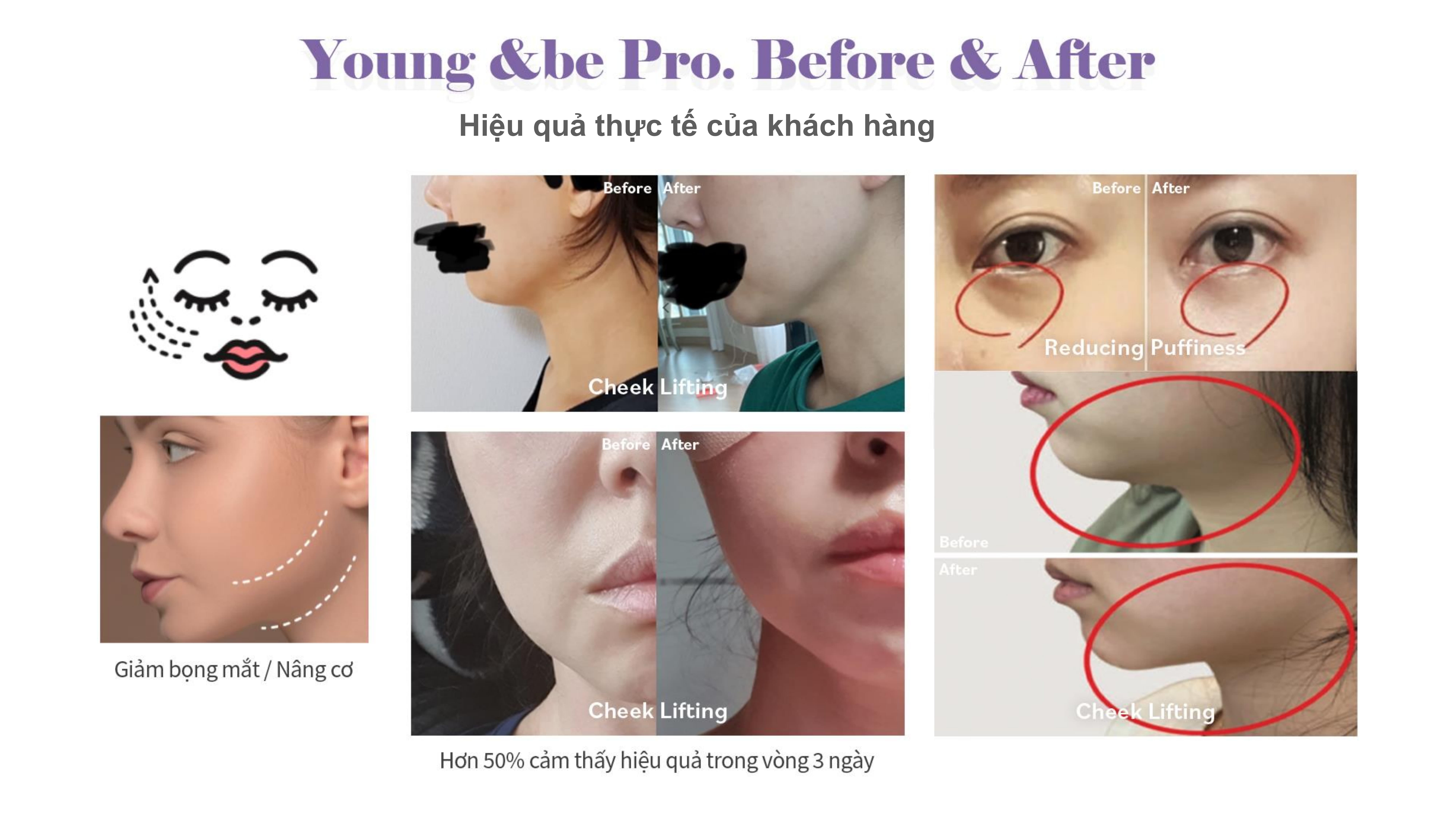 Xóa nhăn rãnh cười bằng máy HIFU cá nhân